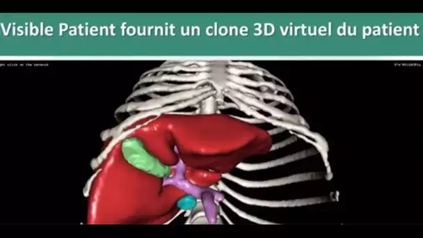 Ces innovations qui font la une à VivaTech : Visible Patient, une nouvelle chirurgie guidée par l…