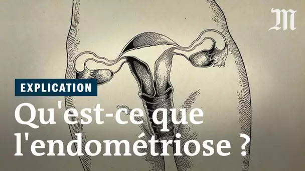 Qu’est-ce que l’endométriose ?