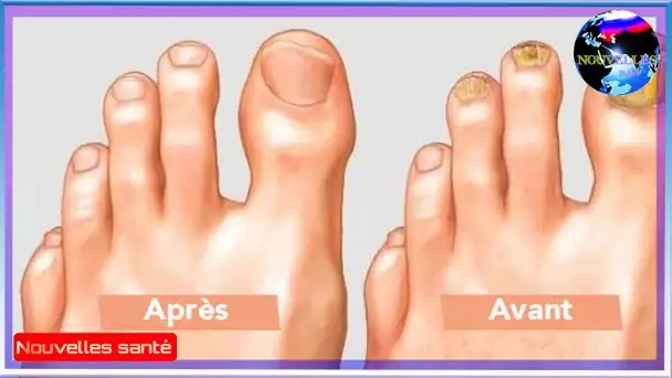 Trempez vos pieds dans ce mélange pour enlever le champignon de vos orteils naturellement!