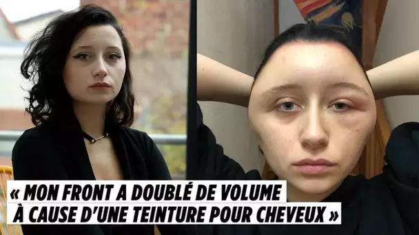 « Mon front a doublé de volume à cause d&#039;une teinture pour cheveux »