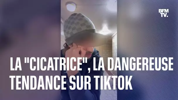 Se créer une cicatrice sur le visage: le nouveau jeu dangereux des ados sur TikTok