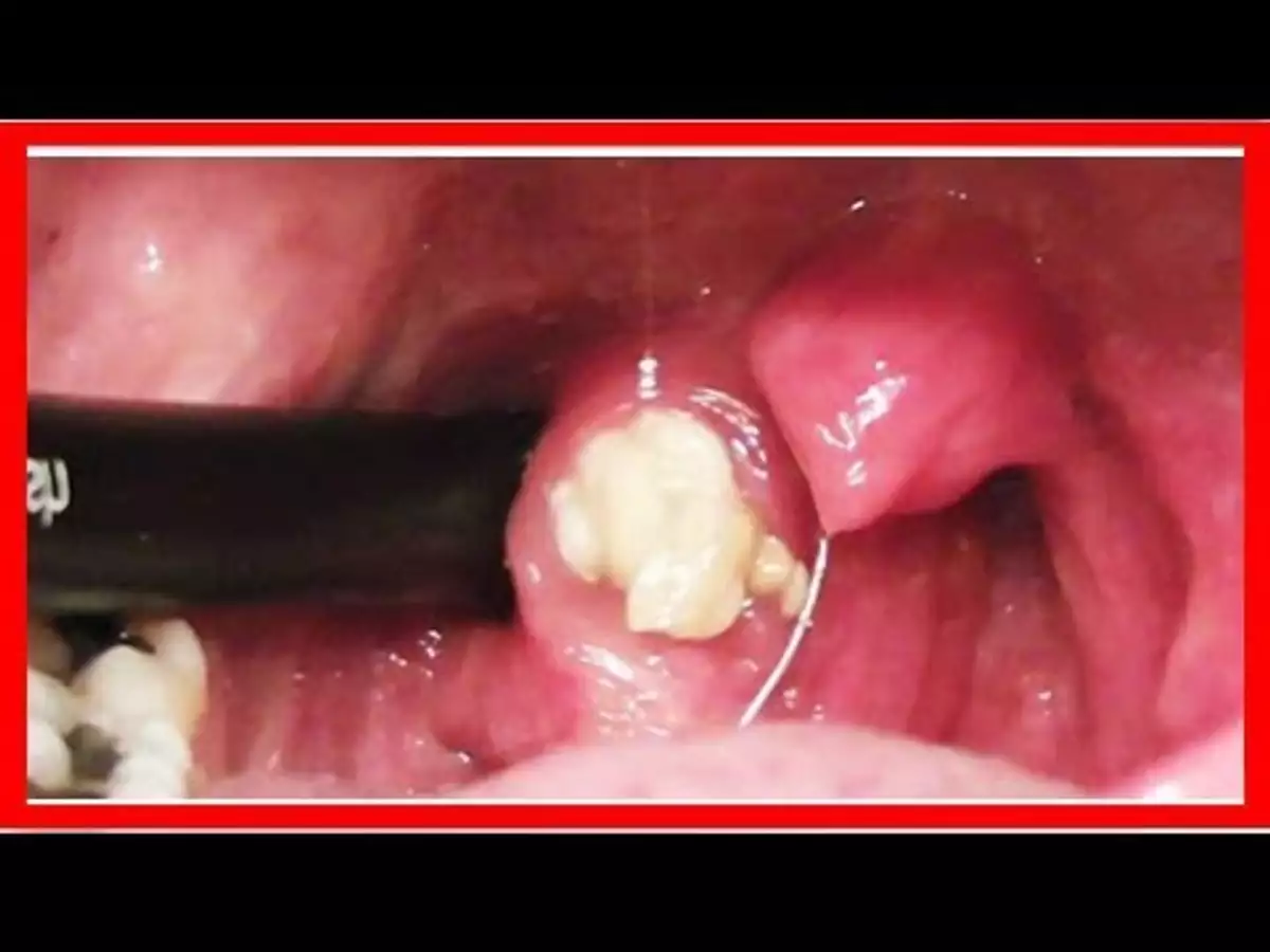 Biggest tonsil stones