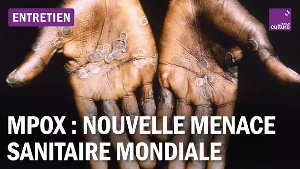 Mpox : sommes-nous prêts pour une nouvelle crise sanitaire mondiale ?