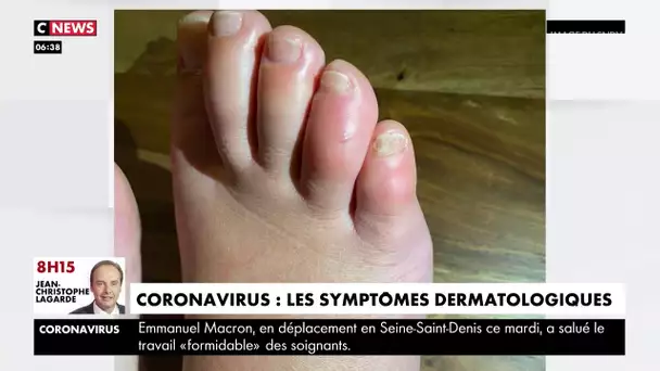 Coronavirus : les dermatologues alertent sur de nouveaux symptômes cutanés