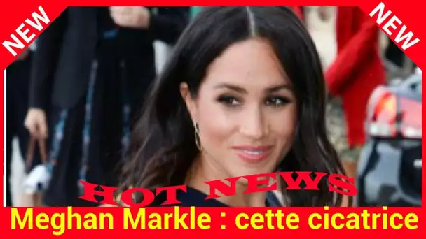 Meghan Markle : cette cicatrice qui témoigne d'une douloureuse opération esthétique