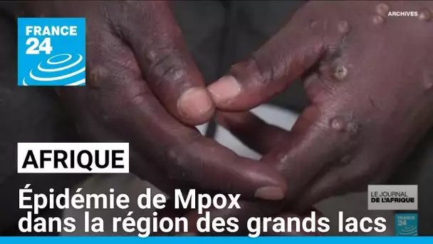 L'épidémie de Mpox se développe dans la région des grands lacs en Afrique • FRANCE 24