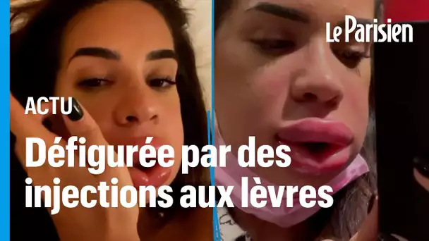 «Elle aurait pu ne plus pouvoir respirer»: une influenceuse défigurée après des injections