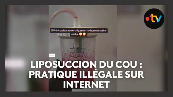 Liposuccion du coup : des pratiques illégales faites par des influenceuses sur les réseaux sociaux