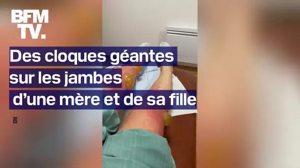 Des cloques géantes apparaissent sur les jambes d’une mère et de sa fille après une sortie au lac