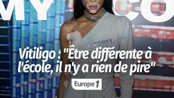 Amandine, 25 ans, atteinte de vitiligo : "Il n'y a rien de pire qu'être différente au moment de l…