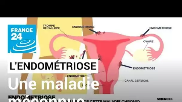 L'endométriose : une maladie méconnue qui touche 10 % des femmes • FRANCE 24